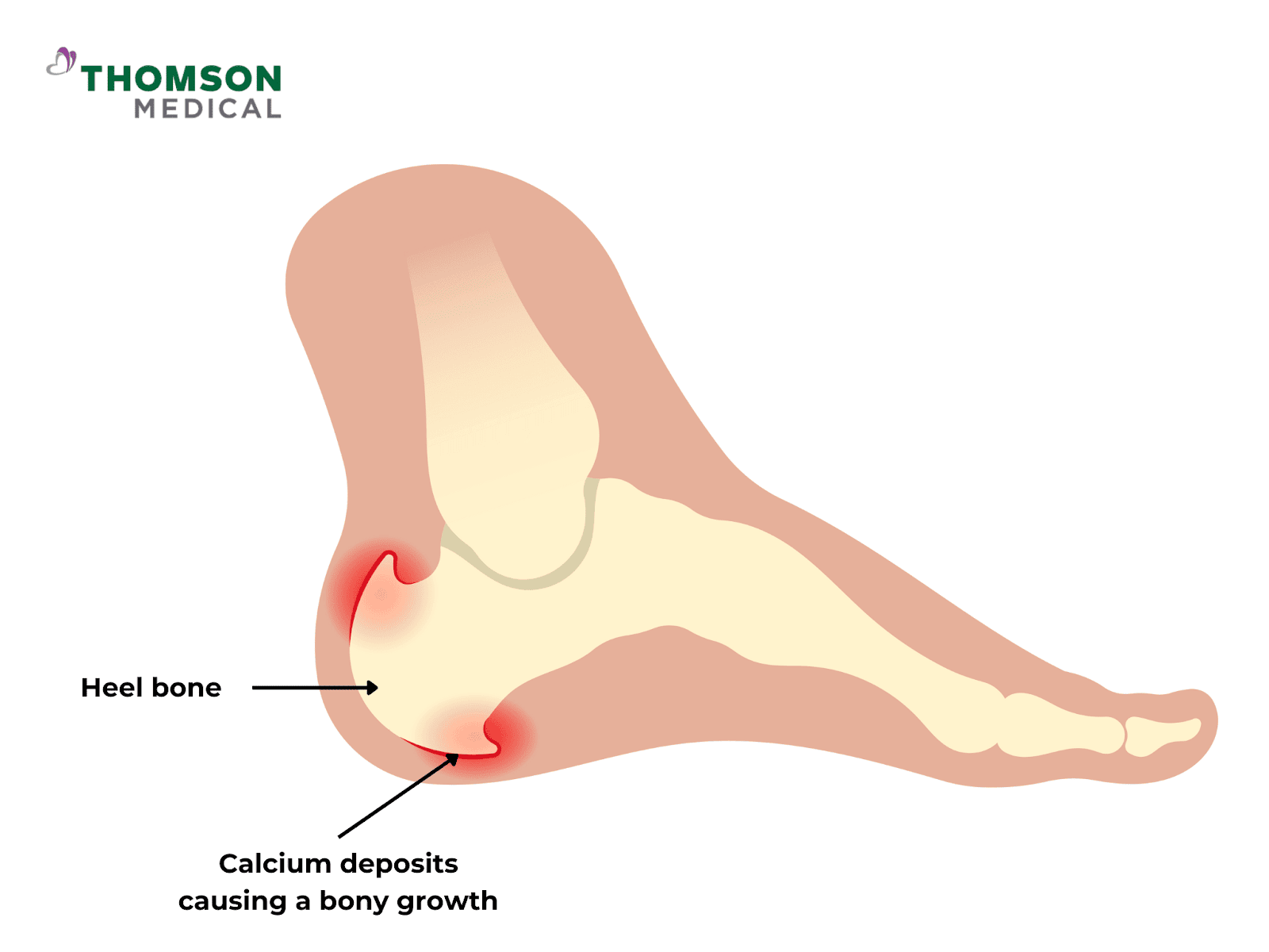 Causes and Treatments for Heel Pain 1 AD 4nXelcBHobPaQqf0S6IbqBHg2vBqxNdCNLlou4i1yyfuP5 b58ph48kdQyeYSqeXGcEO5QWgKODE57qIhY5cATiXyavBtfF4v4R2cQfU 9vuU33VWjSzazo IY8IXpeRp15HEM2sSlg?key=fhTqw NiehlutGgsHVTR9g